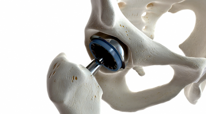 Hip Replacement Medical Negligence