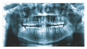 A dental X-ray showing the jaw and teeth.